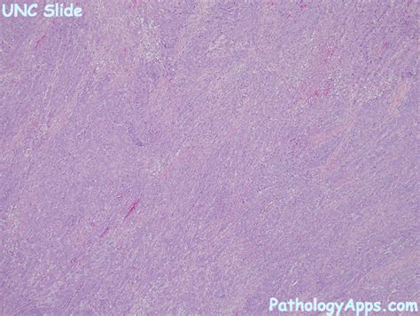 medullary carcinoma pathology