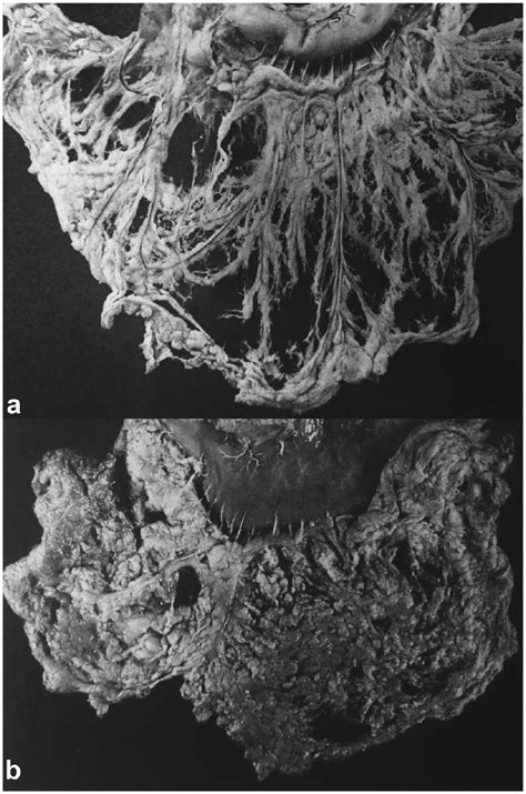 Adult human omentum from (a) a 36-year-old donor with a lean omentum ...