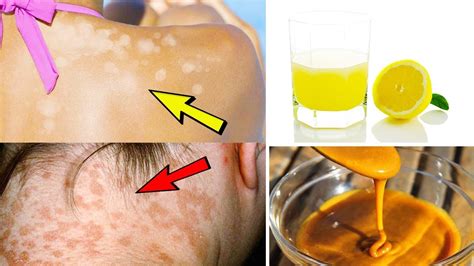 5 Effective Home Remedies For Treating Tinea Versicolor – Home ...