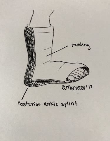 Posterior Splint