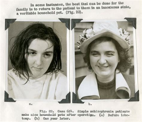 21 Disturbing Pictures of Lobotomy Before and After | Bored Panda