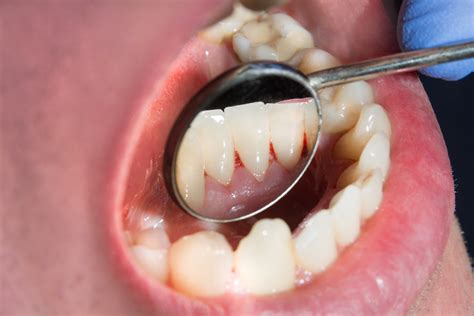 Dental Problems Archives - Dr. Andrés de Cardenas, DMD