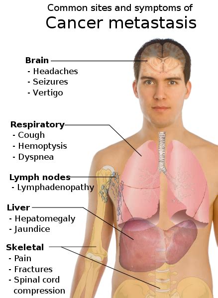 Information of diseases: Symptoms of cancer disease