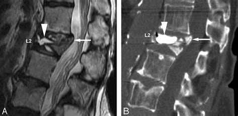 Vertebroplasty for Osteoporotic Fractures with Spinal Canal Compromise | American Journal of ...