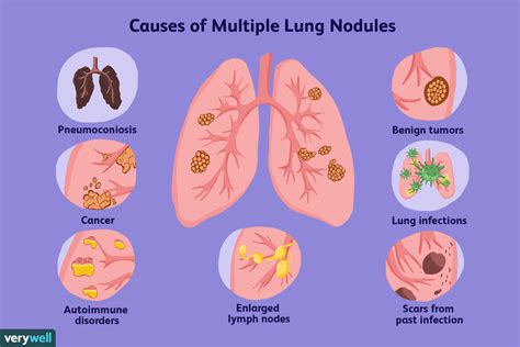 Multiple Lung Nodules: Overview and More | Lunges, Diagnosis, Lung infection