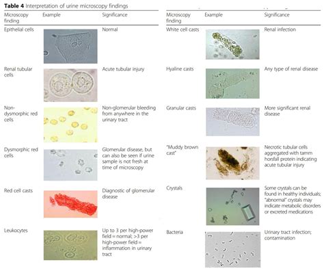 Epithelial Cells In Urine