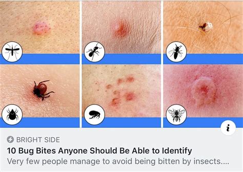 What Do Bedbug Bites Look Like On A Human Body at Mandy Simpkins blog