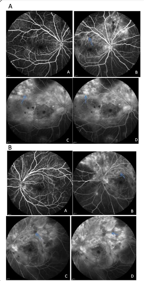 a Fluorescein angiography of the right eye at 1 min (a), 3.30 min (b),... | Download Scientific ...