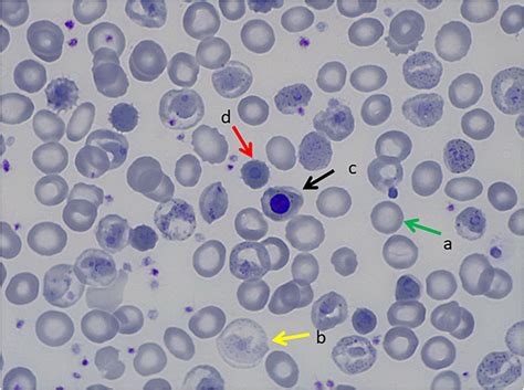 Hemoglobin Inclusion Bodies