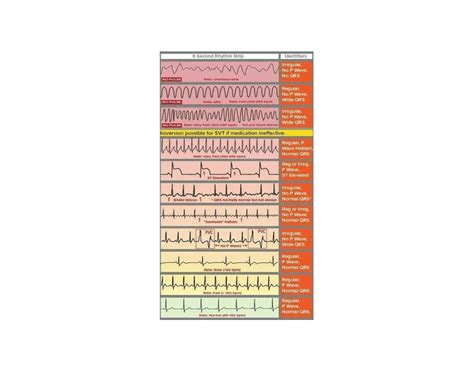 EKG ECG rhythm strip Nclex rn Quiz