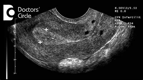 Is pregnancy possible with normal endometrial lining in... | Doovi