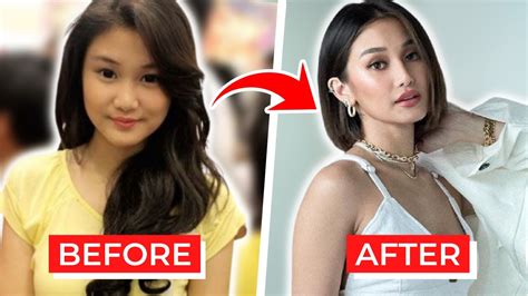 Filipino Nose Job Before And After