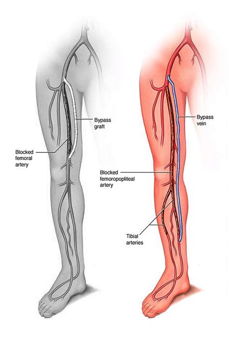 Peripheral Arterial Disease | SFVVG