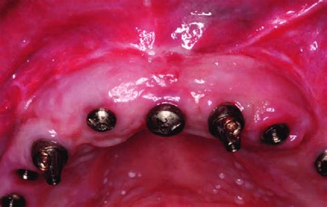 35 The mucogingival junction was positioned approximately 1012 mm ...