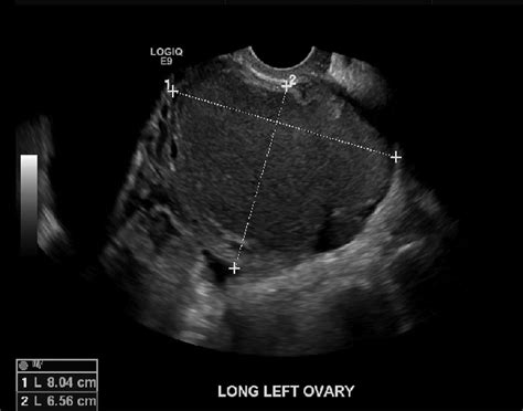 Transvaginal ultrasound scan illustrating left adnexal mass. | Download ...