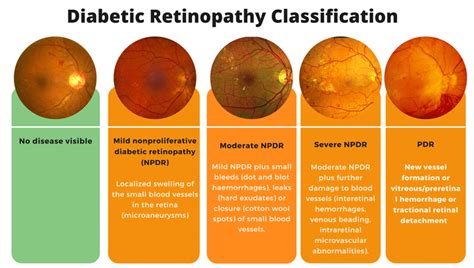 GitHub - Bilal-Belli/DiabeticRetinopathy_ClassificationModel_CNN: This repository contains a ...