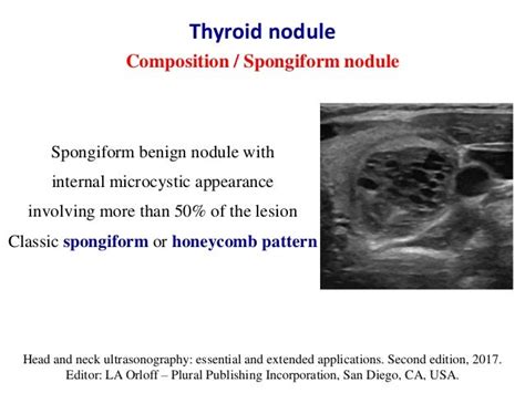 Ultrasound of thyroid nodules