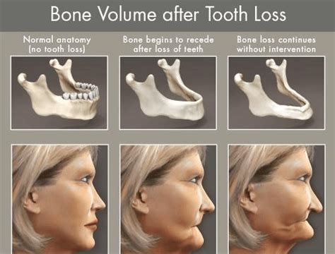 Bone Loss | Ramsey A. Amin, DDS