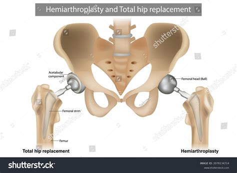 Bipolar Hemiarthroplasty Vs Total Hip Replacement