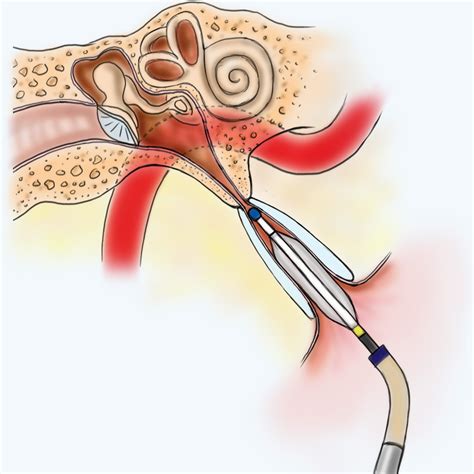 Eustachian Tube Dysfunction - Easmed