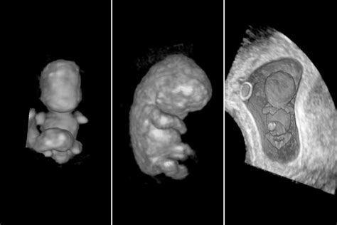 Miscarriages may be more likely to occur with slow developing embryos | New Scientist