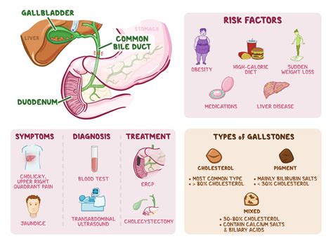 Osmosis - Choledocholithiasis: What Is It, Causes, Diagnosis, Treatment, and More