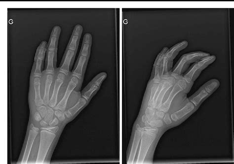 Nonunion of the pisiform bone in a 9-year-old boy | Semantic Scholar