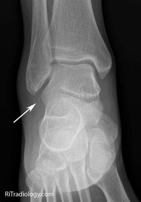 RiT radiology: Fracture of the Lateral Process of Talus