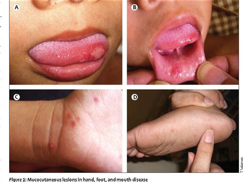 Figure 1 from Clinical features, diagnosis, and management of ...