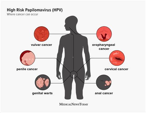 What to know about high risk HPV - VELscope®