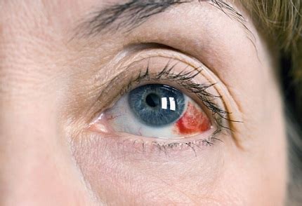 What to Do About Broken Blood Vessel in Eye | Healthcare-Online