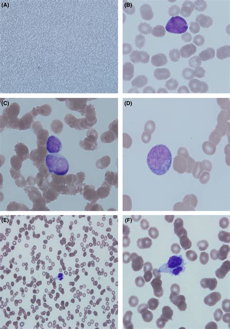 Peripheral blood smear showing: (A) marked pancytopenia. (B and C) Rare ...