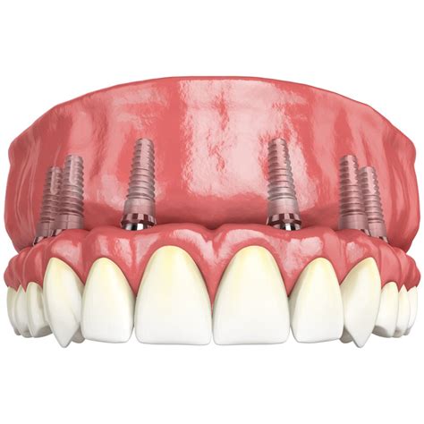 Completely Edentulous Patients with İmplant Supported Fixed