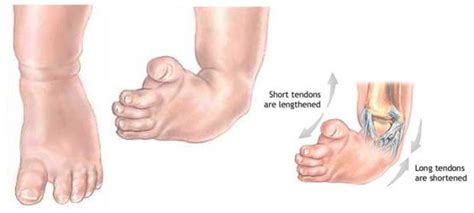 Congenital Talipes Equinovarus (Clubfoot) Nursing Care Management | 다리 운동, 다리