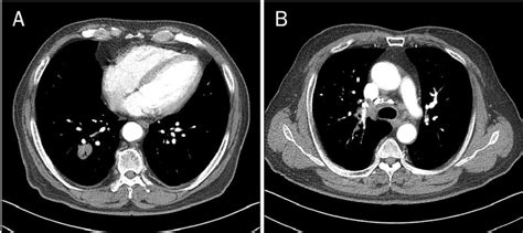 Chest computed tomography shows a 2.2 cm-sized spiculated nodule in... | Download Scientific Diagram