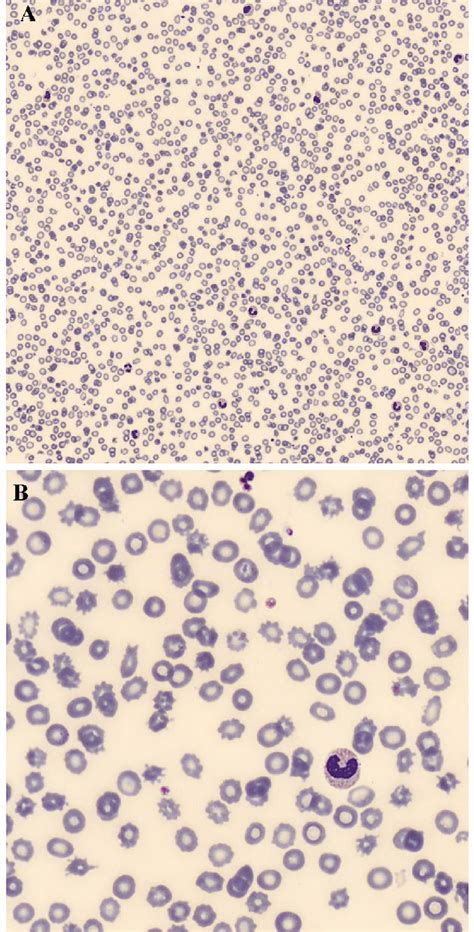 A Peripheral blood smear from the cirrhotic patient, showing spur ...