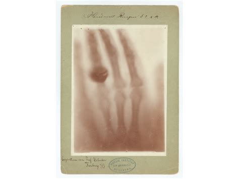 125 ans de rayons X : une histoire de pur hasard, de sous-vêtements et la percée du « patient de ...