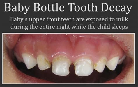 Tooth Decay and baby bottle | Dr. Nechupadam Dental Clinic