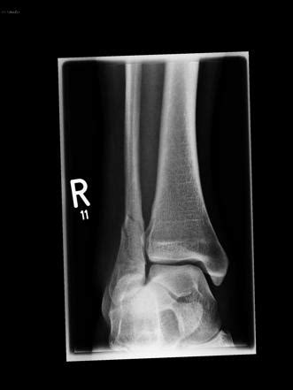 Ankle fracture - Weber C | Image | Radiopaedia.org