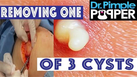 Top Terrible Pus Cyst Removal & Popping Pimple | Dr. Pimple Popping - YouTube