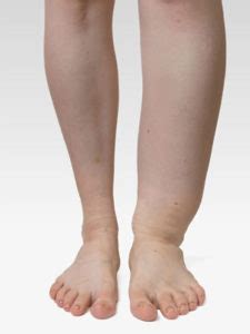 Compression Stockings Edema | Comprogear