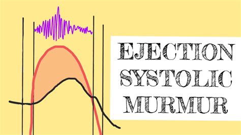 What Is Early Systolic Murmur - BEST HOME DESIGN IDEAS