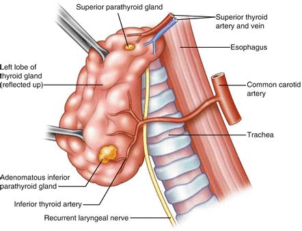 Parathyroidectomy Treatment