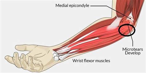 Pop or snap in elbow - Armwrestling - The GripBoard