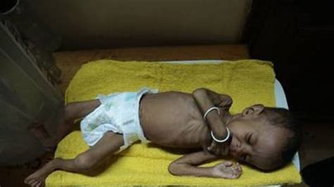 Yemen: One million malnourished children at risk of cholera