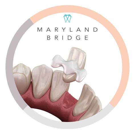 DENTAL BRIDGE