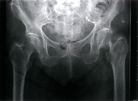 Intertrochanteric Fracture Xray