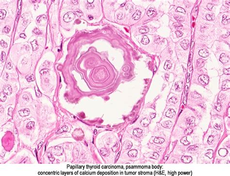 Pathology Outlines - Papillary thyroid carcinoma