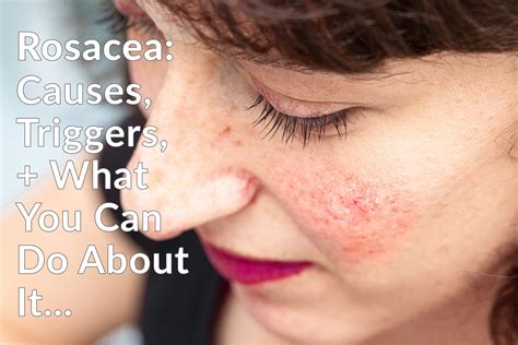 Rosacea - Causes, Triggers & What You Can Do About It