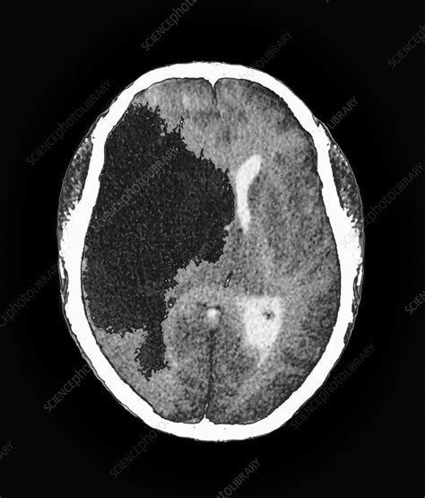 Stroke, CT scan - Stock Image - C015/2732 - Science Photo Library